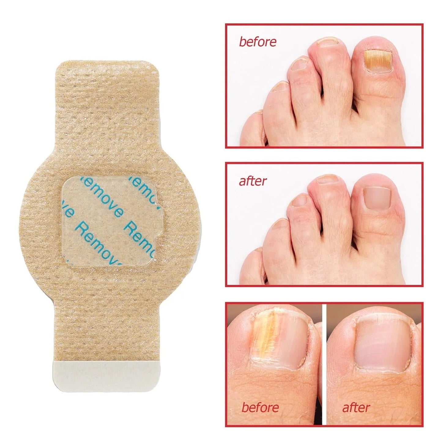 NailHeal™ - Fungal Nail Patches 🌿💅 ( Buy 1 Get 1 Free🔥🔥) Regular price