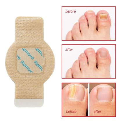 NailHeal™ - Fungal Nail Patches 🌿💅 ( Buy 1 Get 1 Free🔥🔥) Regular price